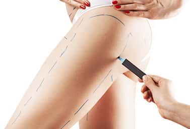 thigh lift surgery in india