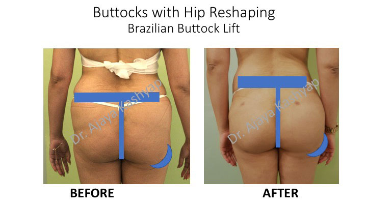 brazilian butt lift surgeon in india