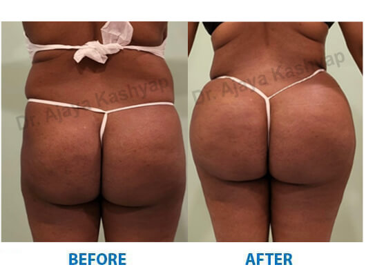 brazilian butt lift surgery cost in india