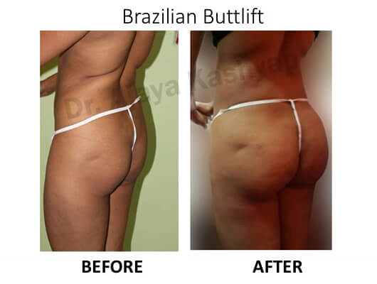 brazilian butt lift surgery cost in india