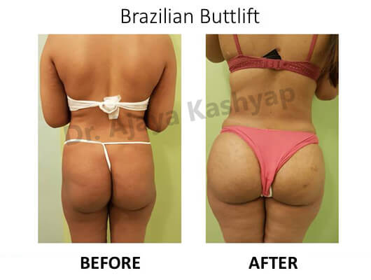 brazilian butt lift clinic in delhi