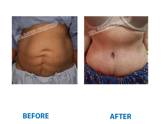 body contouring surgery in India