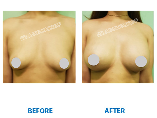 Breast Augmentation Surgeon