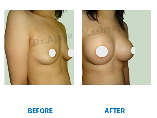 Breast Augmentation price