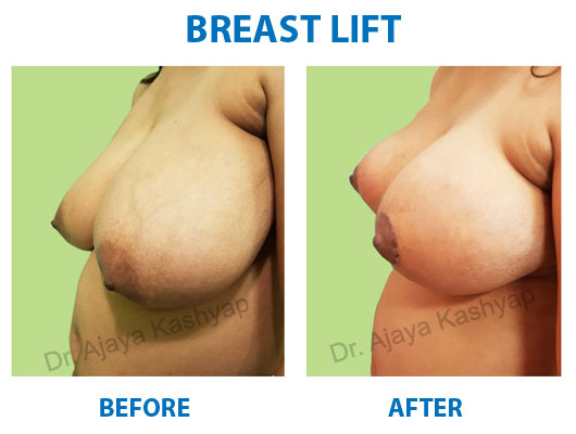 Breast Lift clinic