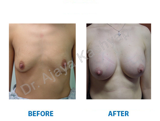 Breast Augmentation surgery in delhi